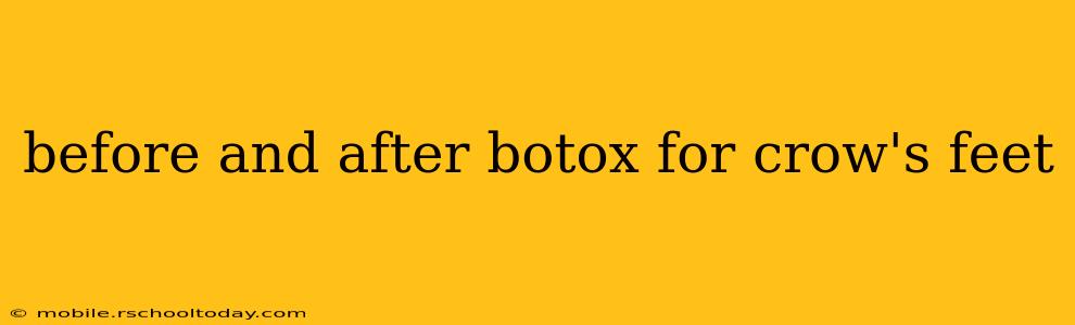 before and after botox for crow's feet