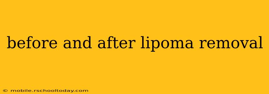 before and after lipoma removal