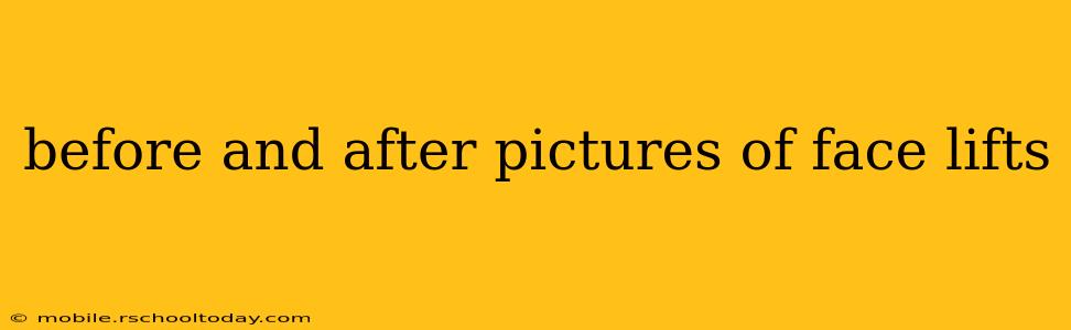 before and after pictures of face lifts