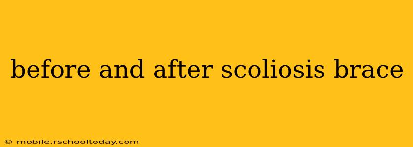 before and after scoliosis brace