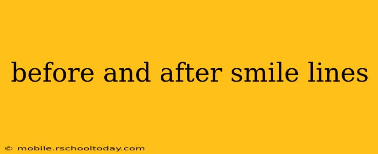 before and after smile lines