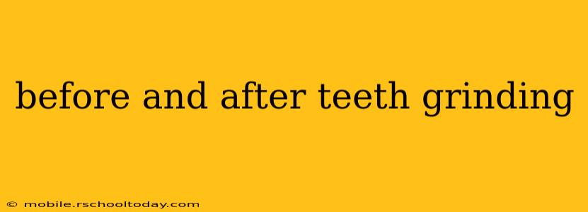 before and after teeth grinding