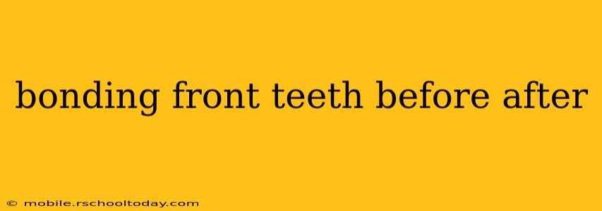 bonding front teeth before after