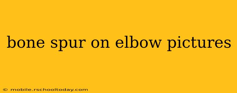 bone spur on elbow pictures