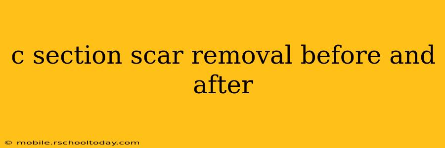 c section scar removal before and after