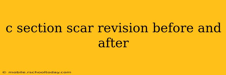 c section scar revision before and after