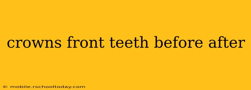 crowns front teeth before after