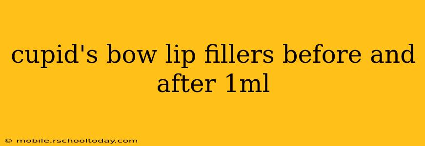 cupid's bow lip fillers before and after 1ml