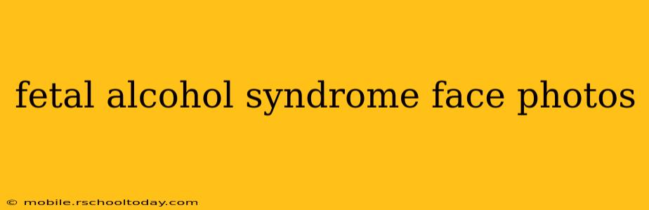 fetal alcohol syndrome face photos
