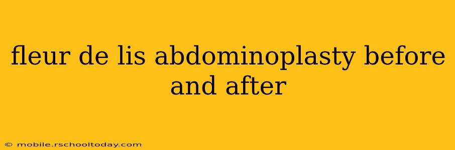 fleur de lis abdominoplasty before and after