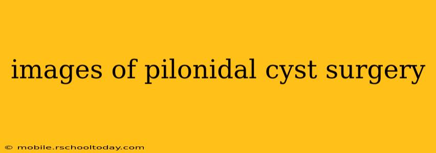 images of pilonidal cyst surgery