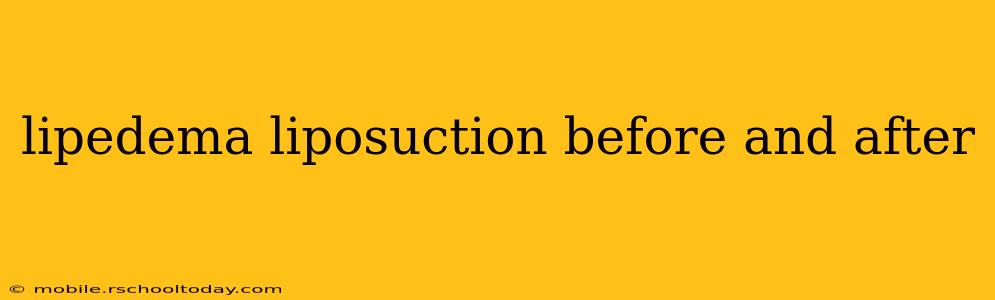 lipedema liposuction before and after