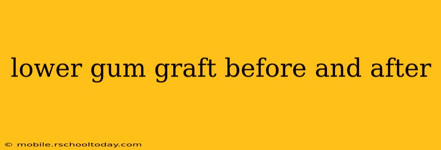 lower gum graft before and after