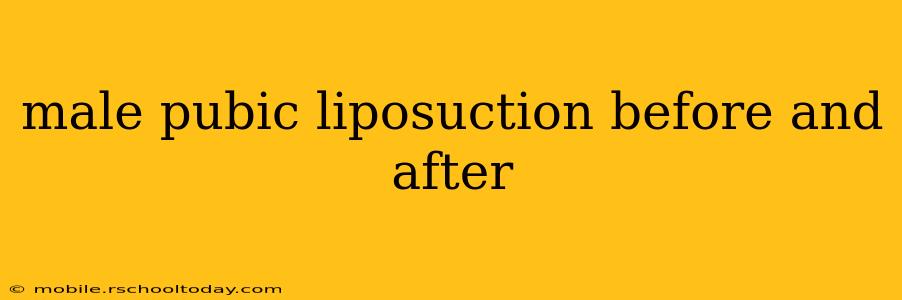 male pubic liposuction before and after