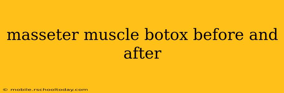 masseter muscle botox before and after