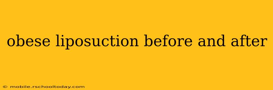 obese liposuction before and after