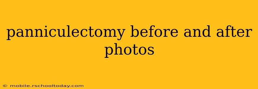 panniculectomy before and after photos
