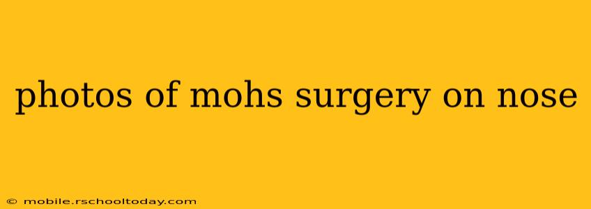 photos of mohs surgery on nose