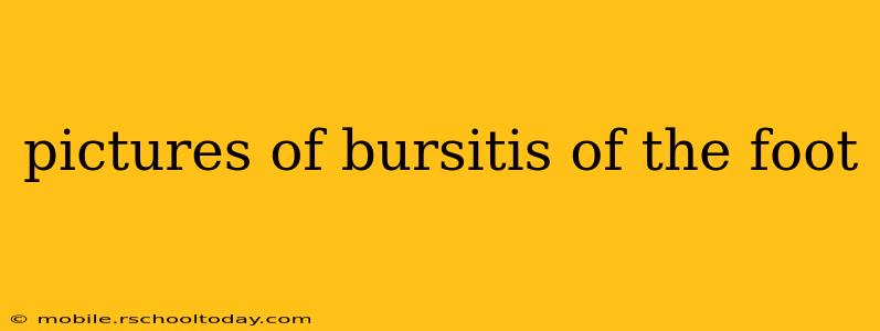 pictures of bursitis of the foot