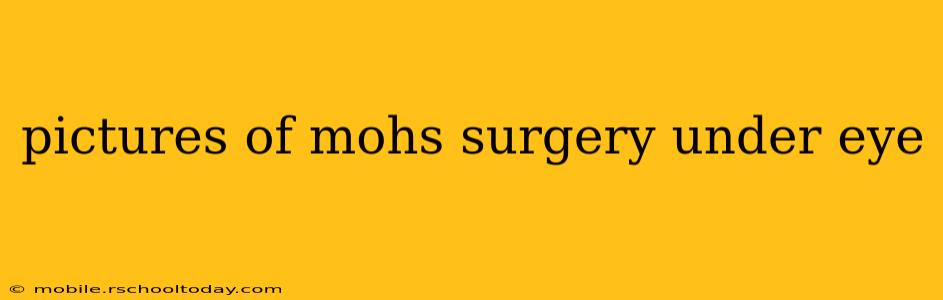 pictures of mohs surgery under eye