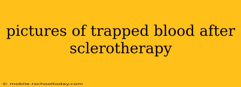 pictures of trapped blood after sclerotherapy