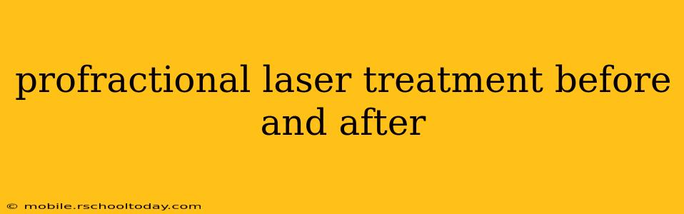 profractional laser treatment before and after