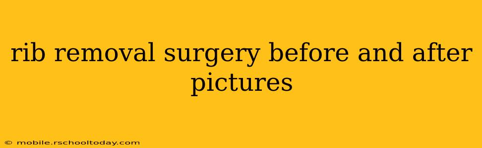 rib removal surgery before and after pictures
