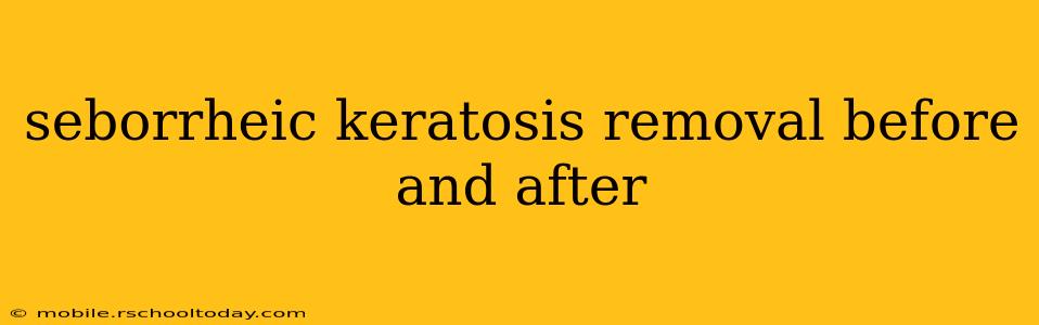 seborrheic keratosis removal before and after