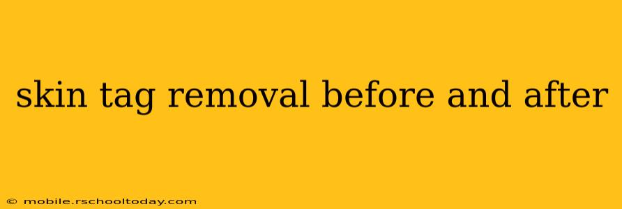skin tag removal before and after