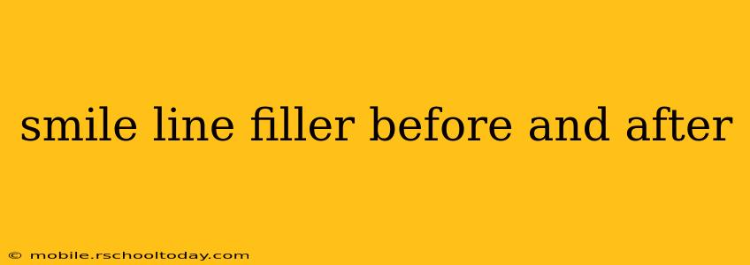 smile line filler before and after