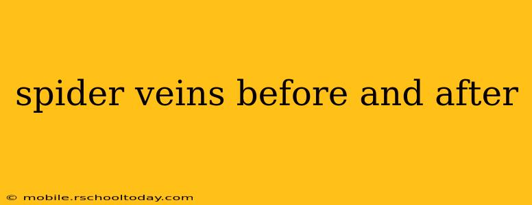 spider veins before and after