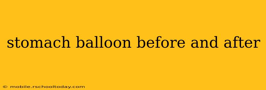 stomach balloon before and after