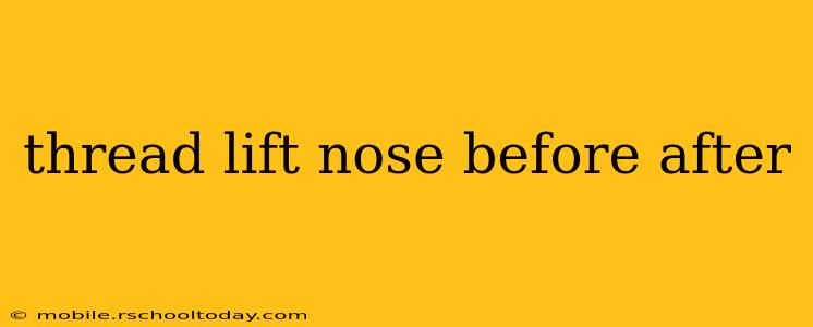 thread lift nose before after