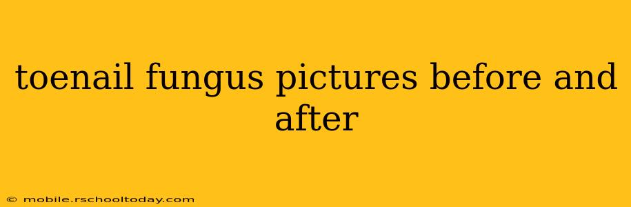 toenail fungus pictures before and after
