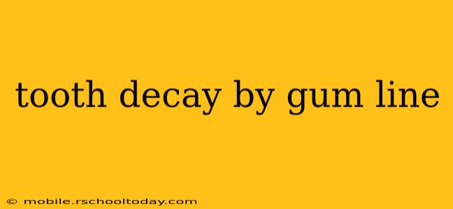 tooth decay by gum line