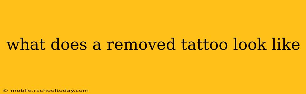 what does a removed tattoo look like
