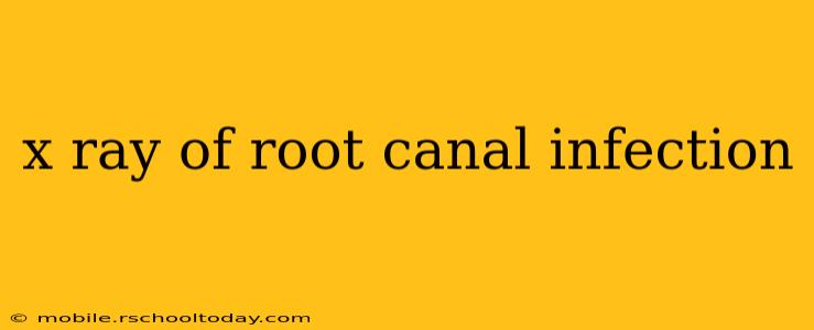 x ray of root canal infection